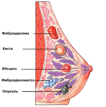 Как выглядят фиброаденомы в молочных железах, рисунок